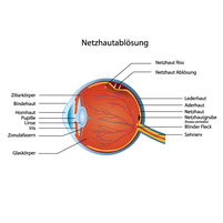 Laserbehandlung Netzhaut